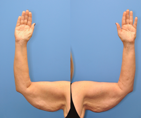 gallery before image