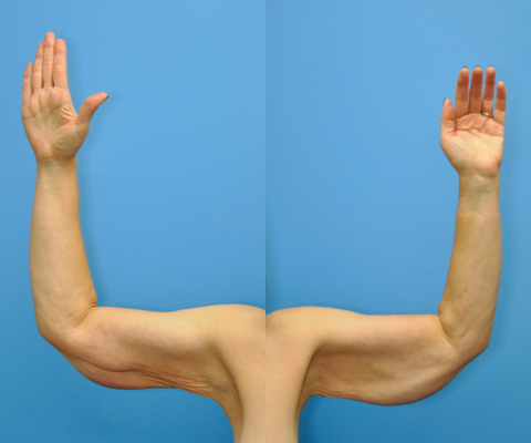 gallery before image