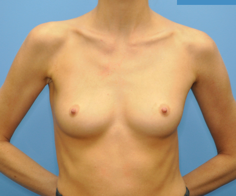 gallery before image