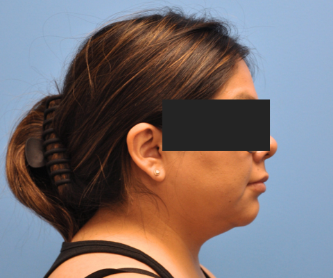 gallery before image