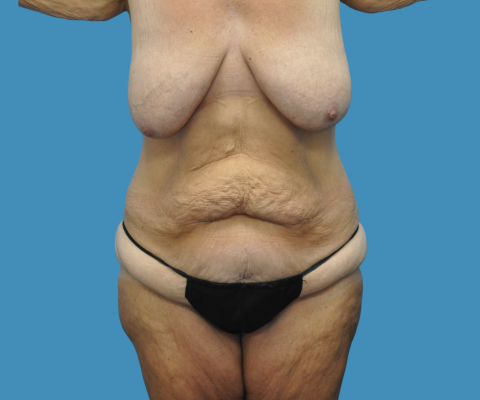 gallery before image