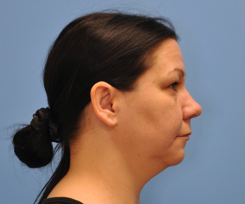 gallery before image