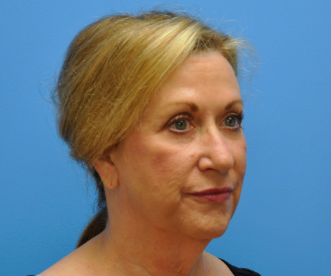 gallery before image