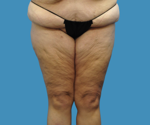 gallery before image