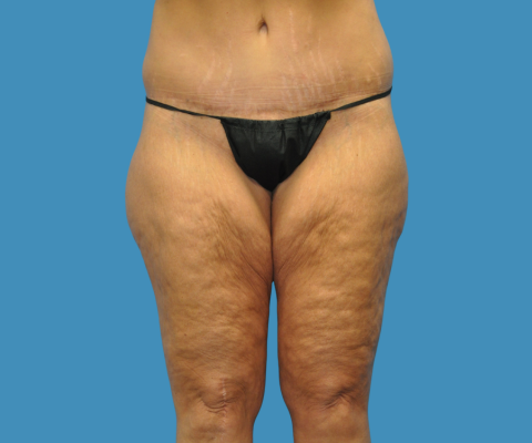 gallery before image