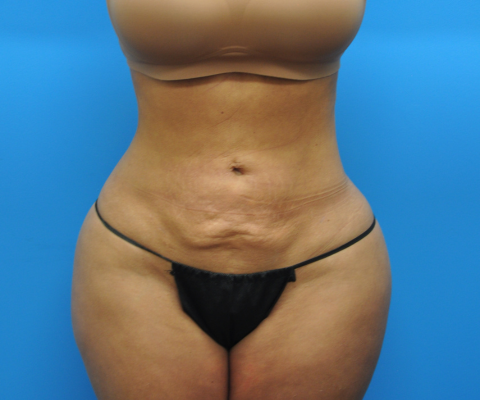 gallery before image