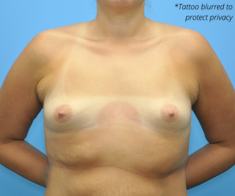 gallery before image