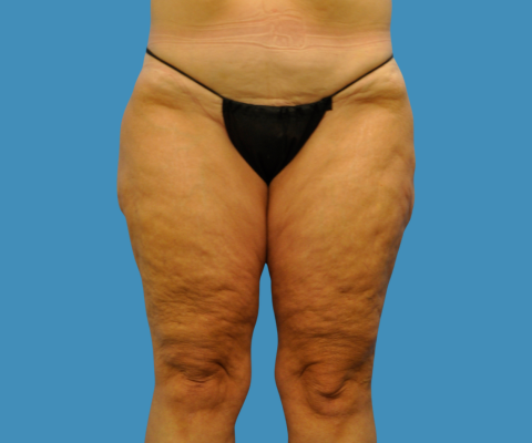 gallery before image