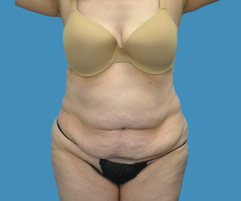 gallery before image