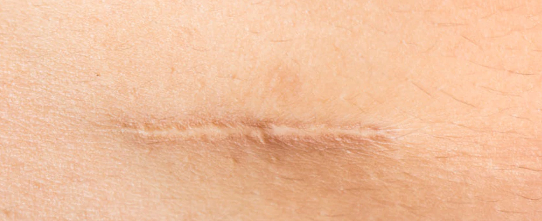 Dr. Jack's Scar Care Instructions image